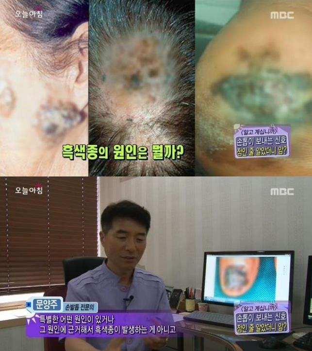 [내일의원] 손톱 발톱에 검은 선 "흑색종" 관련 이미지 2