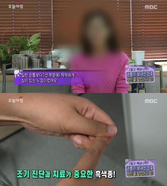 [내일의원] 손톱 발톱에 검은 선 "흑색종" 관련 이미지 7