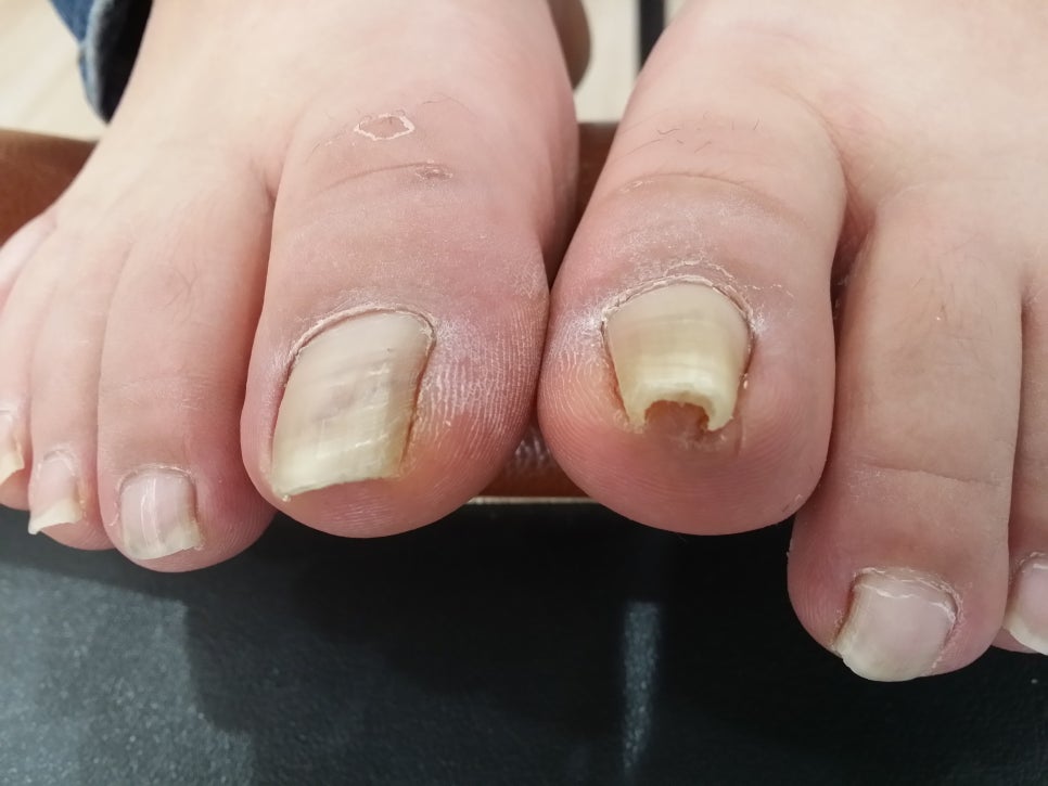 발톱무좀 과 내향성 발톱 관련 이미지 5