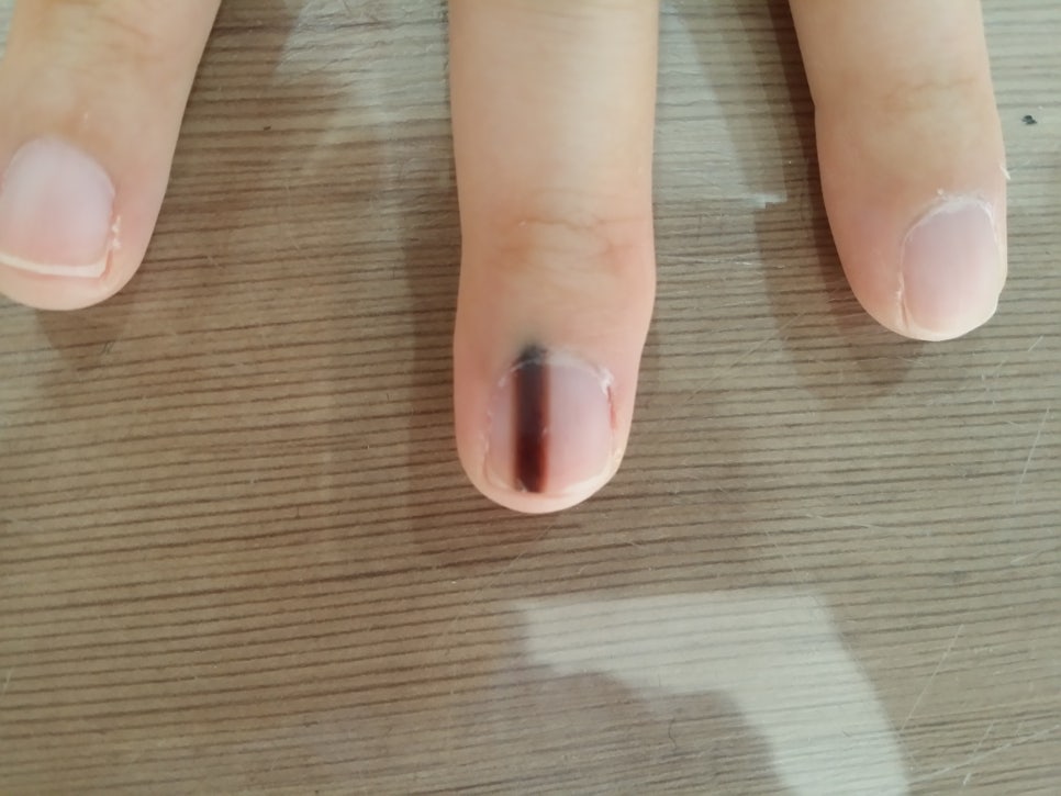 발톱무좀과 흑색종 손발톱 관련 이미지 1