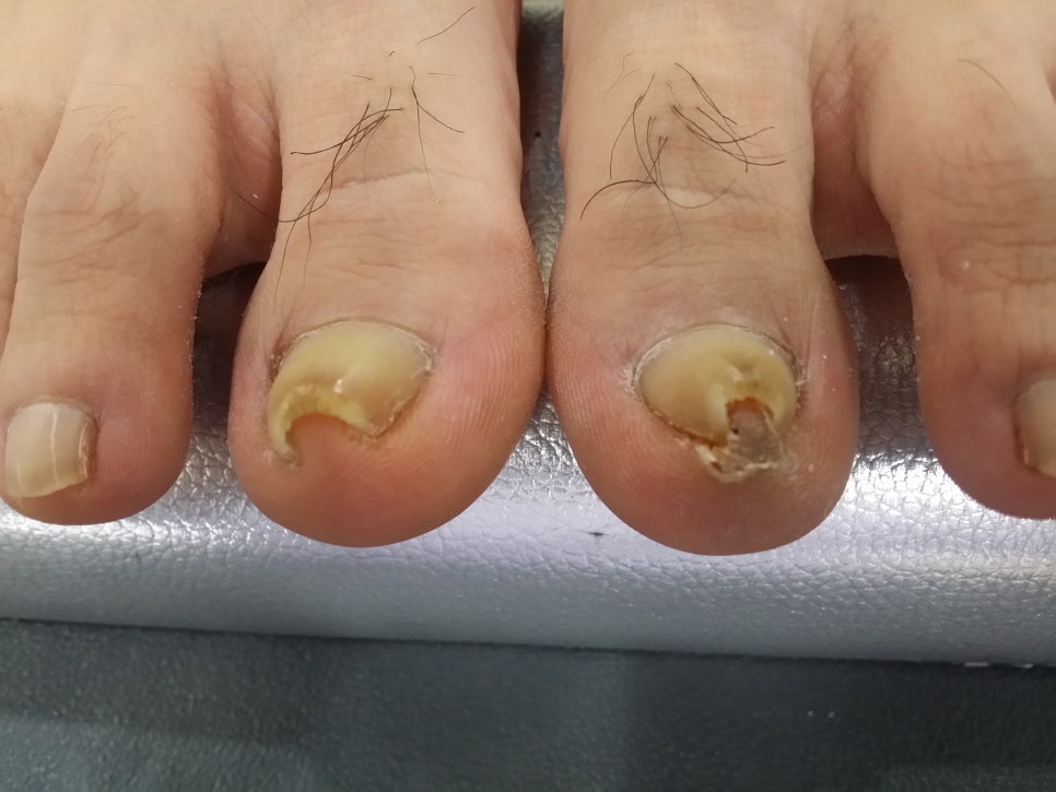 발톱무좀 과 심한 내향성 발톱이 동반된경우 관련 이미지 1