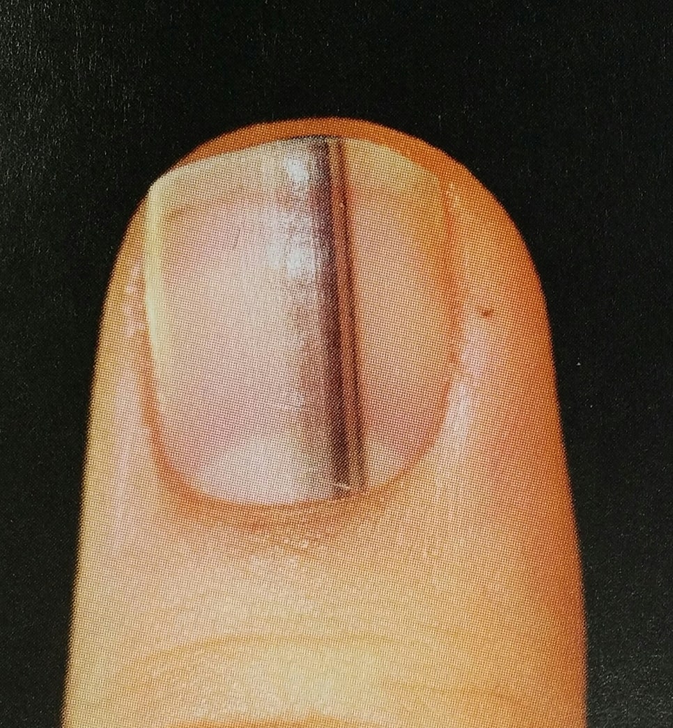 손발톱 흑색종과 새해인사 관련 이미지 3