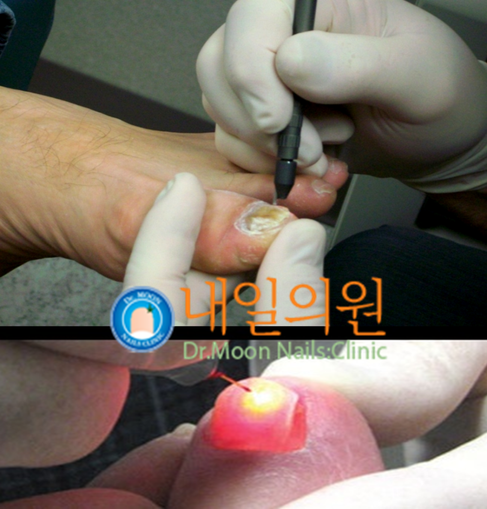 [내일의원] 발톱무좀 레이저 치료 안내 및 정보 관련 이미지 1