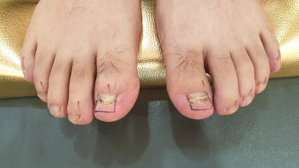 발톱무좀과 내성발톱70(콜로세움) 관련 이미지 16