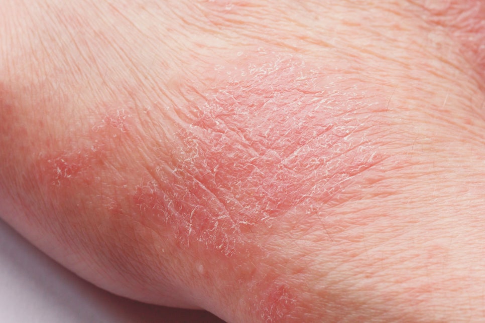 서초구 피부과 아토피 피부염으로 밤잠을 설치고 계시다면 주목 관련 이미지 3