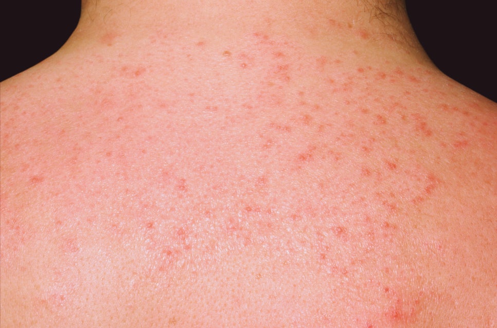 사당역 피부과 모공각화증 치료 매끈한 팔다리를 위한 맞춤 치료법 관련 이미지 1