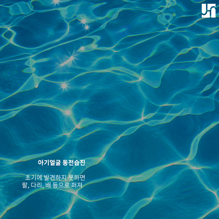 아기 얼굴 동전습진이 생겼다면... 관련 이미지 4