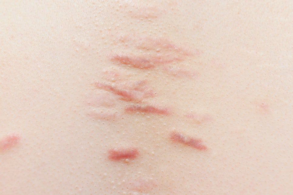 Sadang Station Dermatology: Keloid Scar Treatment—Don’t Ignore a Scar That Keeps Growing and Itching image 3