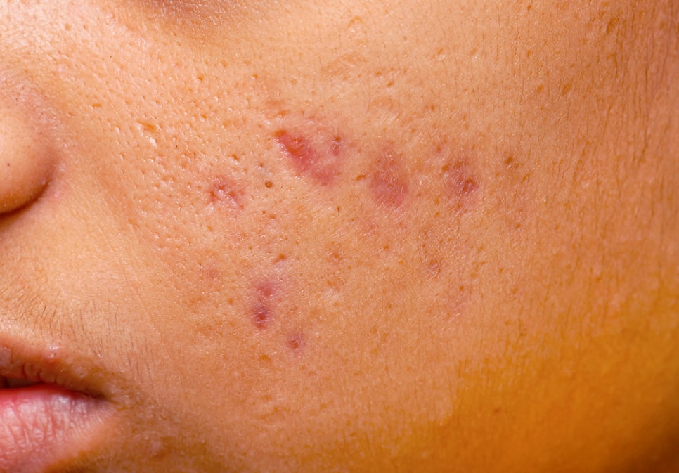 방배동 피부과 여드름 흉터 치료 패인 자국과 거친 결 개선하는 방법 관련 이미지 3