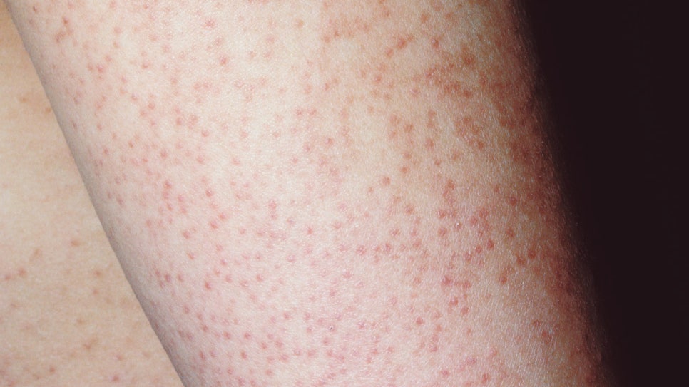 사당역 피부과 모공각화증 치료 매끈한 팔다리를 위한 맞춤 치료법 관련 이미지 2