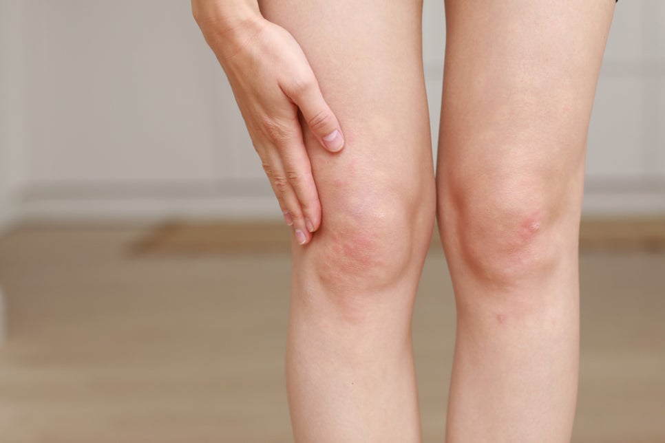 Naebang Station Dermatology: Causes of Hives—There Is a Reason If Your Skin Suddenly Swells and Itches image 3