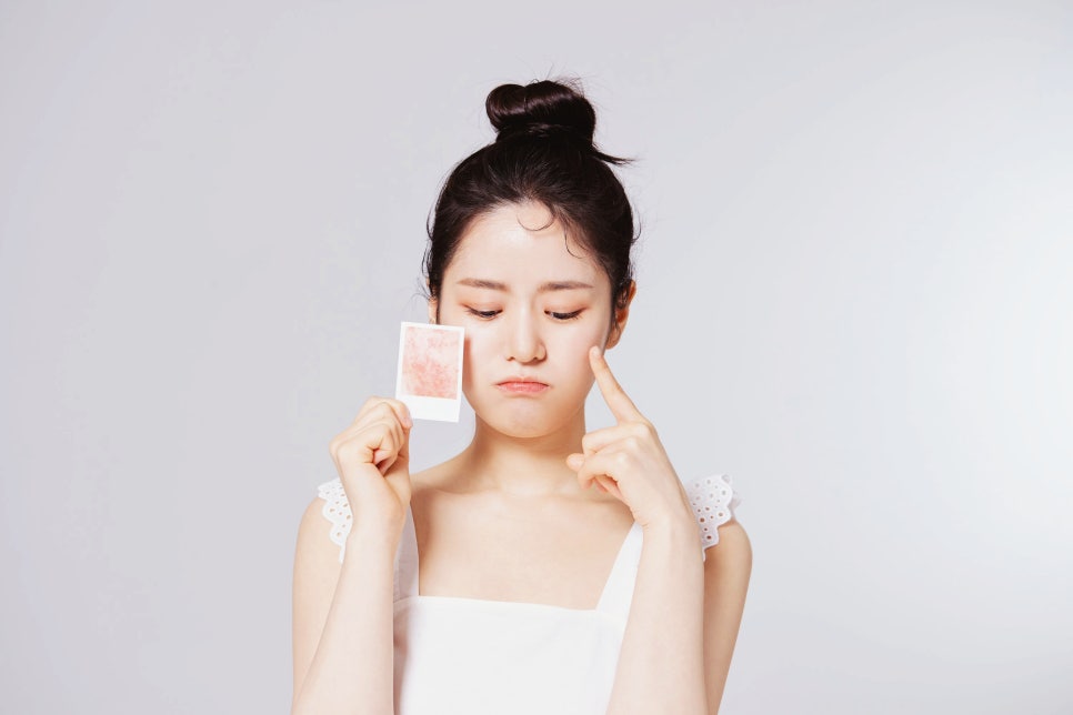 내방동 피부과 모낭염 원인과 증상 여드름과 헷갈리지 마세요 관련 이미지 4