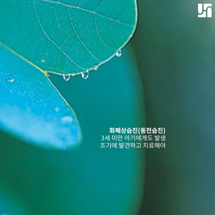 건조한 겨울에 발생하기 쉬운 화폐상습진 관련 이미지 4