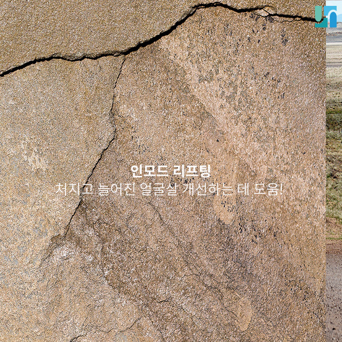 인모드 리프팅으로 처지고 늘어진 얼굴살 개선해 봐요! 관련 이미지 1