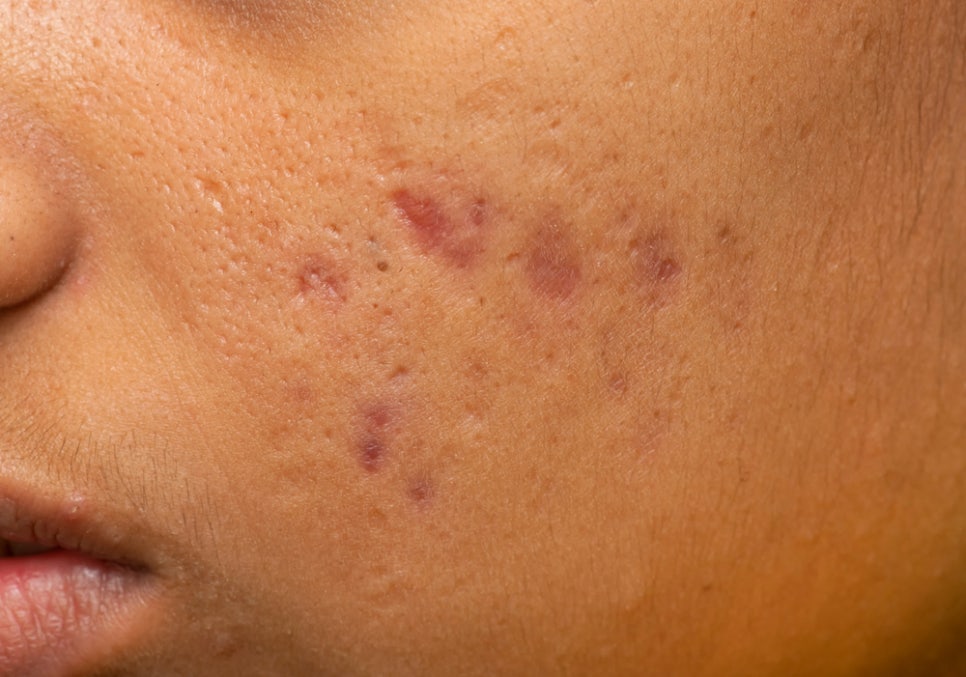 내방동 피부과 여드름흉터 레이저치료 뭘 받아야할지 고민이신가요? 관련 이미지 1