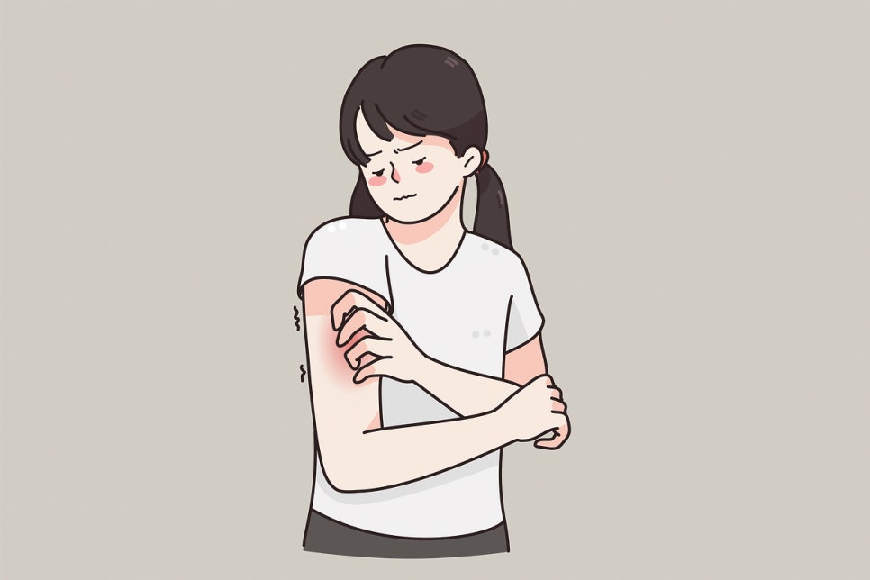 Naebang Station Dermatology: Causes of Hives—There Is a Reason If Your Skin Suddenly Swells and Itches image 5