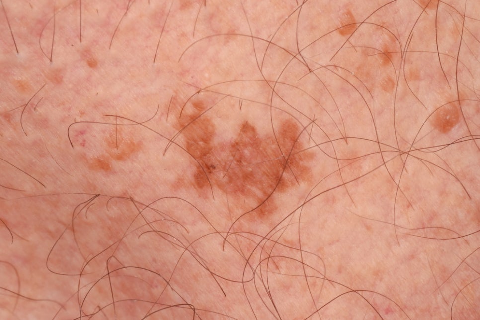 Bangbae Station Dermatology: Laser Removal of Age Spots—Don’t Leave Brown Spots That Develop with Age Untreated image 3