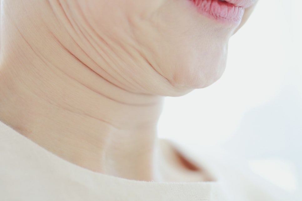 Seocho-gu Dermatology Clinic: Improving a Double Chin—There Is a Separate Reason It Does Not Disappear Even After Losing Weight image 1
