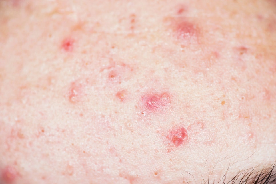 내방 피부과 원장이 알려주는 여드름 부위별 원인과 맞춤 관리법 관련 이미지 1