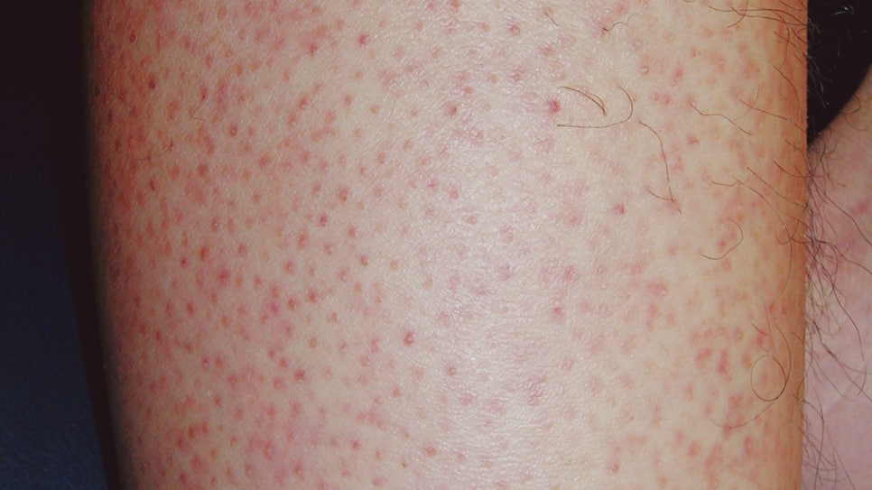 사당역 피부과 모공각화증 치료 매끈한 팔다리를 위한 맞춤 치료법 관련 이미지 3