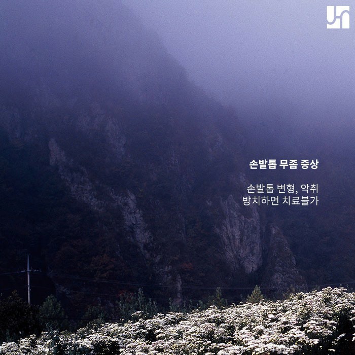 불쾌하고 불편한 무좀, 핀 포인트 레이저로 간편하게 치료! 관련 이미지 2