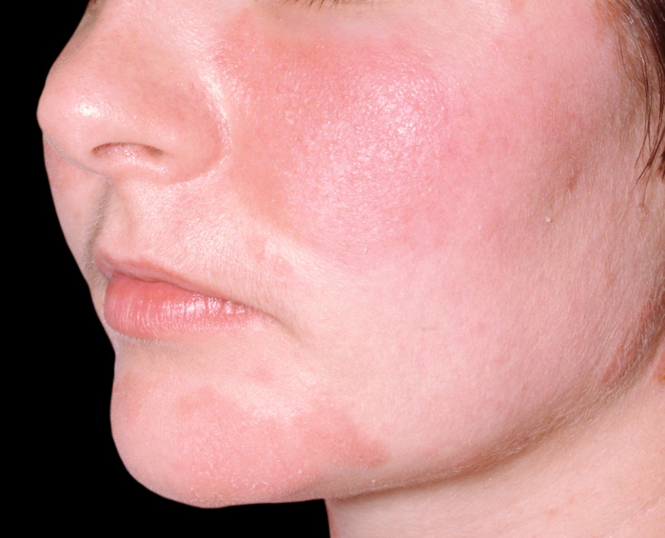 Sadang Station Dermatology Clinic: Causes and Symptoms of Seborrheic Dermatitis—It’s Different from Simple Dry Skin image 1