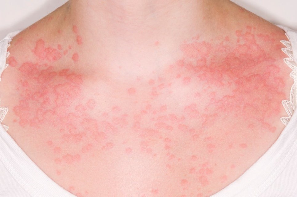 Naebang Station Dermatology: Causes of Hives—There Is a Reason If Your Skin Suddenly Swells and Itches image 1