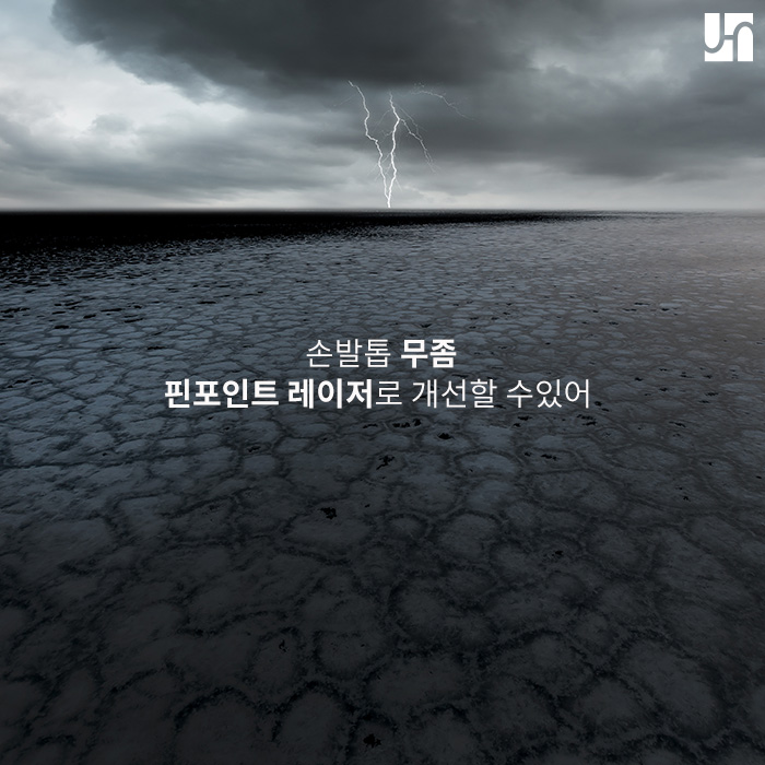 손발톱 무좀, 핀포인트 레이저로 개선할 수 있어 관련 이미지 1