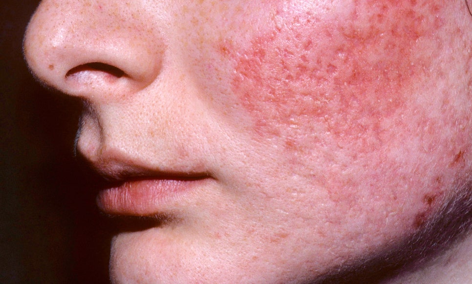 방배동 피부과 여드름 흉터 치료 패인 자국과 거친 결 개선하는 방법 관련 이미지 2