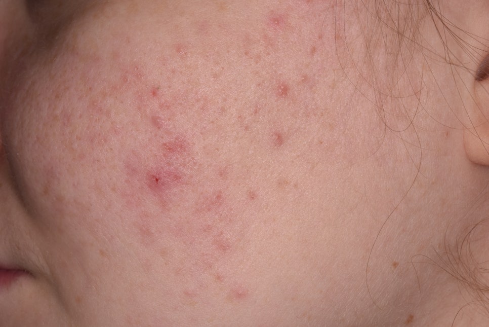 서초 피부과 여드름인줄 알았는데.. 모낭염 원인과 증상은? 관련 이미지 1