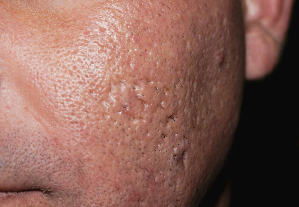 How to Smooth Skin Texture with a Laser for Enlarged Pores at Bangbae-dong Dermatology image 2