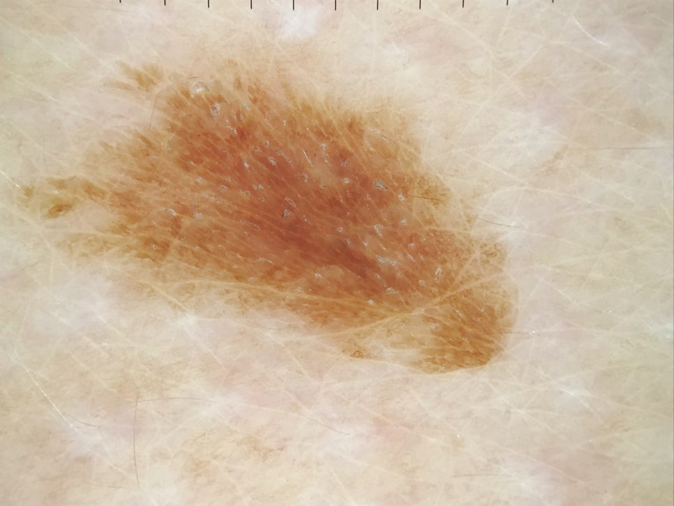 사당동 피부과 피부 색소침착 원인과 효과적인 레이저 치료법 관련 이미지 2