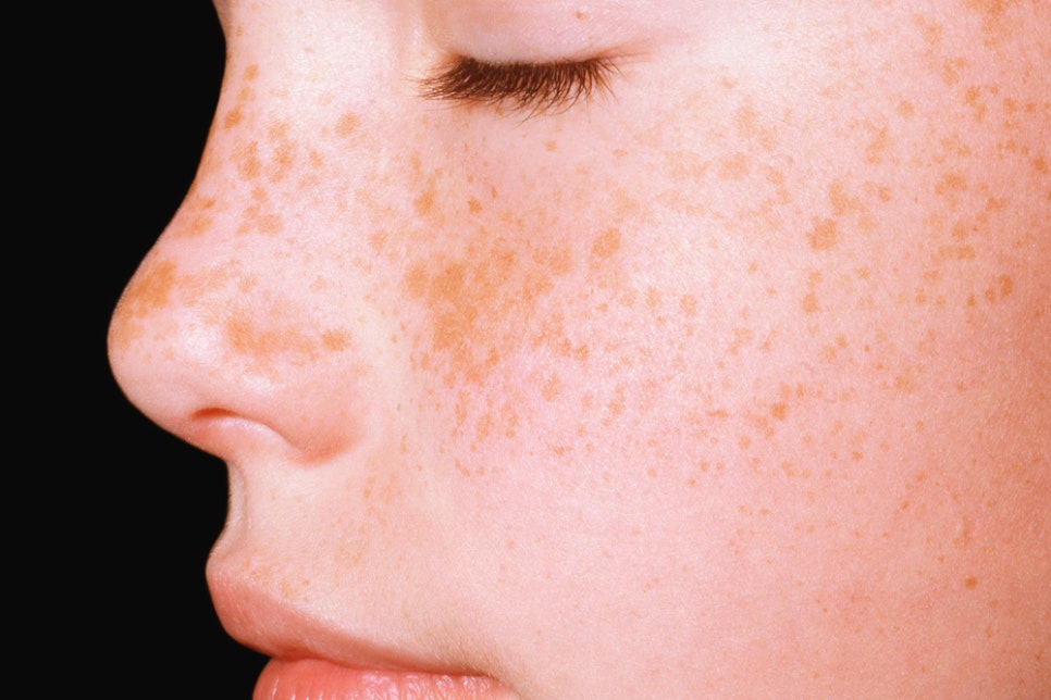 Bangbae Station Dermatology: Laser Removal of Age Spots—Don’t Leave Brown Spots That Develop with Age Untreated image 1