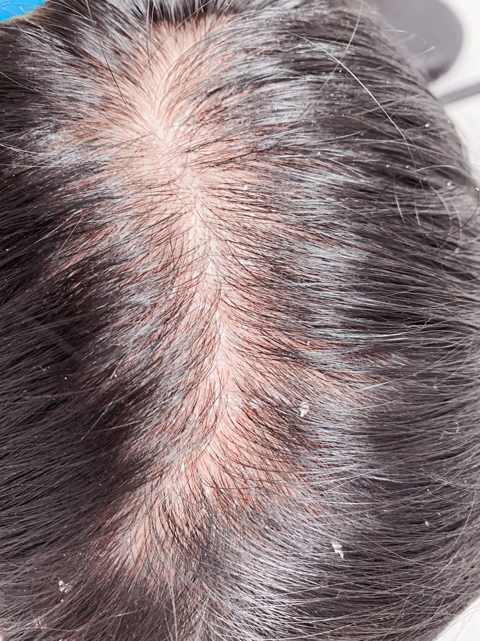 내방역 피부과 두피 지루성 각화증 원인과 자가진단 방법 관련 이미지 2