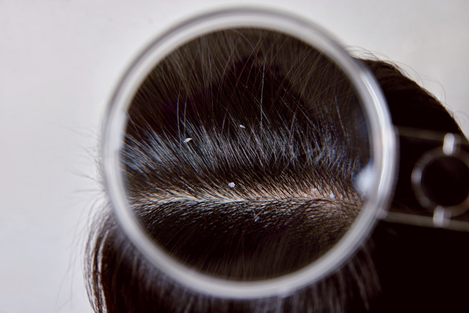 서초동 피부과 머리 비듬 생기는 원인, 지루성 두피염일까? 관련 이미지 1