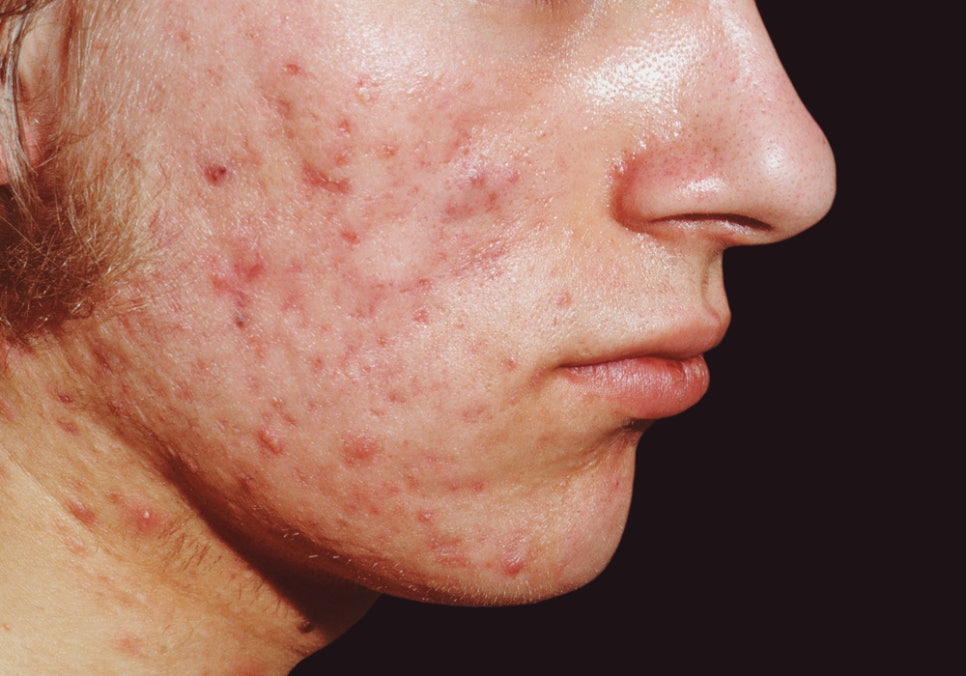Seocho-gu Dermatology Clinic: How to Remove Dark Marks Left Behind After Scars, Hyperpigmentation, and Wounds Heal image 1