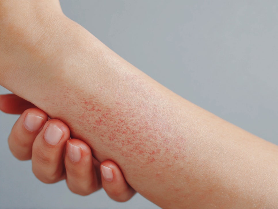 서초구 피부과 아토피 피부염으로 밤잠을 설치고 계시다면 주목 관련 이미지 2