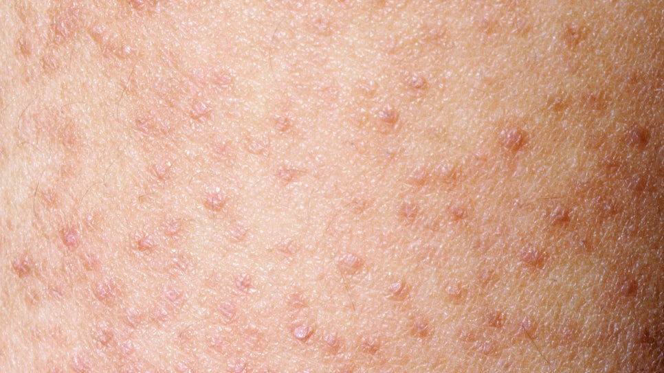 서초구 피부과 모공각화증 치료 닭살 피부 없애는 올바른 피부관리법 관련 이미지 2