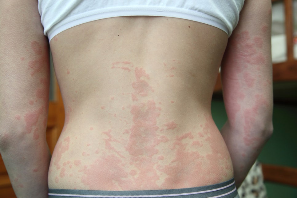 Naebang Station Dermatology: Causes of Hives—There Is a Reason If Your Skin Suddenly Swells and Itches image 4