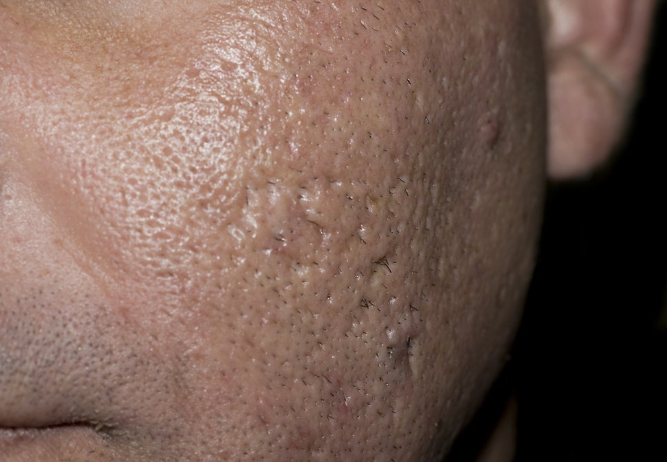 내방동 피부과 여드름흉터 레이저치료 뭘 받아야할지 고민이신가요? 관련 이미지 2