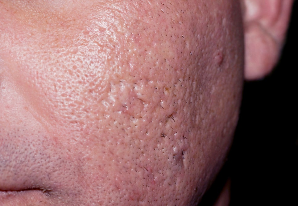 방배동 피부과 여드름 흉터 치료 패인 자국과 거친 결 개선하는 방법 관련 이미지 1