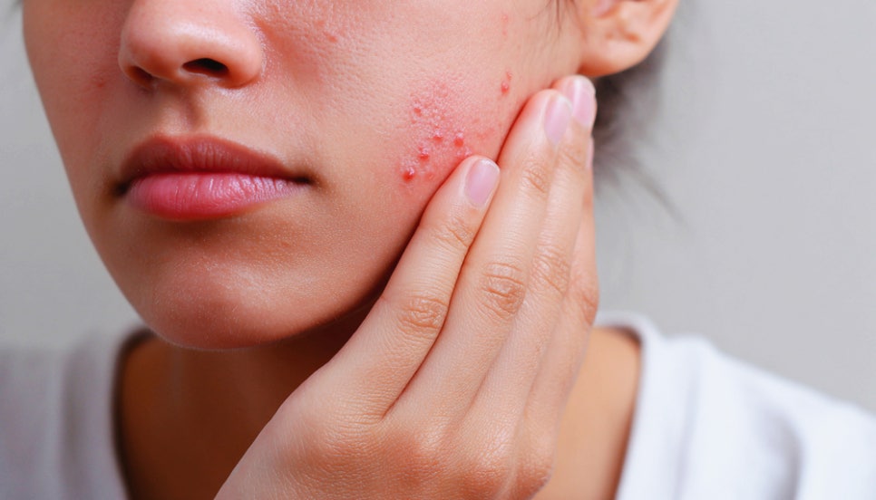 Bangbae Station Dermatology: If Excess Sebum, Acne, Shine, and Recurrent Breakouts Keep Appearing, There Is a Reason image 1