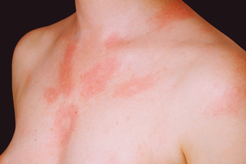 내방동 피부과 자외선 알레르기 피부과 치료 효과와 외출 시 꼭 지켜야 할 주의사항 관련 이미지 3