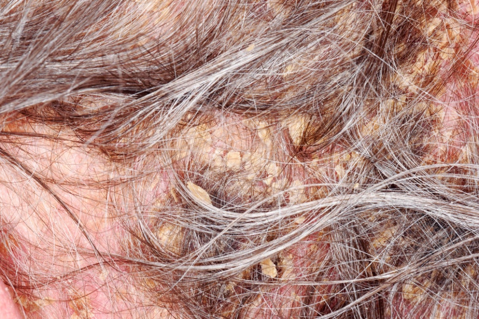 내방역 피부과 두피 지루성 각화증 원인과 자가진단 방법 관련 이미지 1