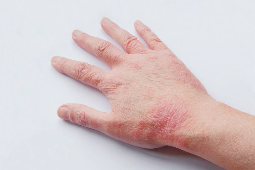 서초구 피부과 아토피 피부염으로 밤잠을 설치고 계시다면 주목 관련 이미지 1