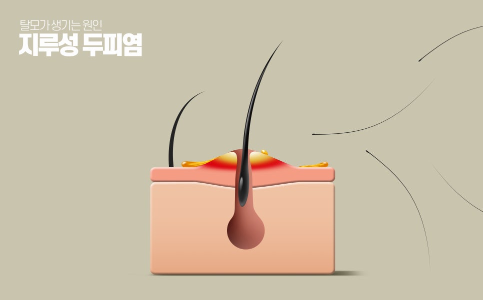 방배역 피부과 지루성 두피염 매일 머리를 감아도 비듬이 떨어지고 가렵다면? 관련 이미지 4