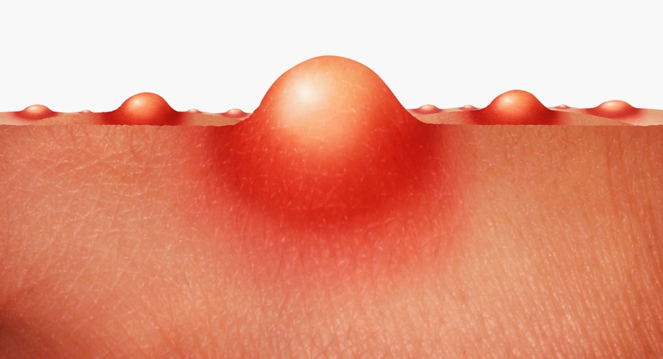 사당역 피부과 가을 여드름 원인 여름보다 오히려 가을에 트러블이 심해지는 이유가 있어요 관련 이미지 3