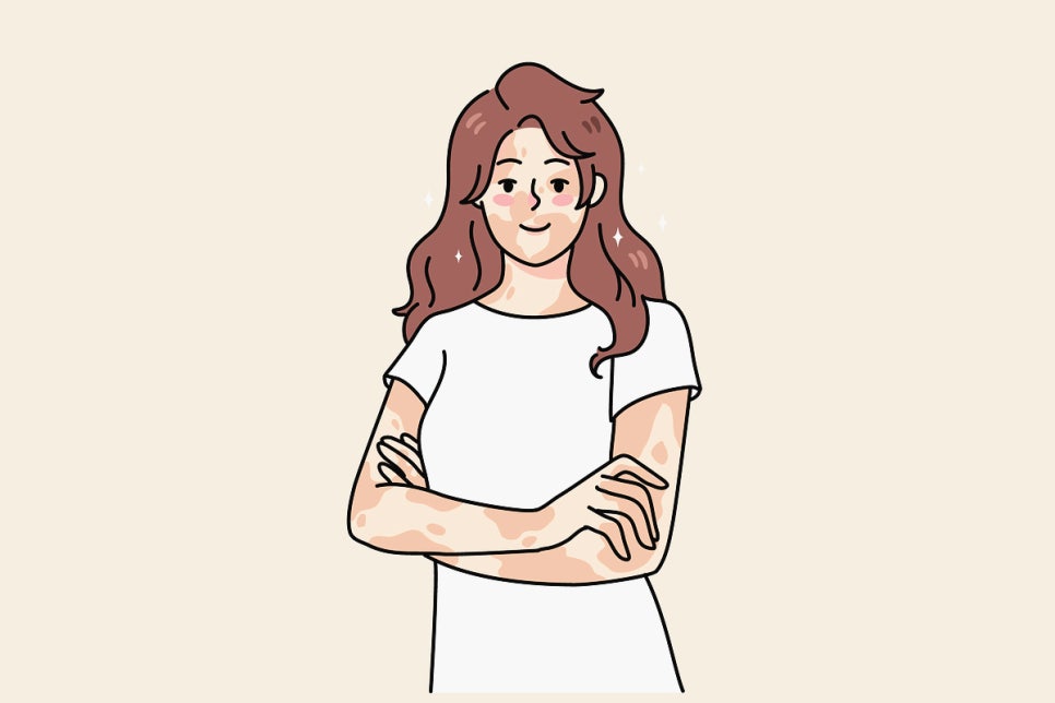 서초역 피부과 백반증 치료 하얗게 탈색된 피부 방치하면 범위가 넓어질 수 있어요 관련 이미지 3