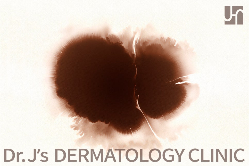 누구에게나 생기는 화상흉터, 빠르게 치료하세요 관련 이미지 1