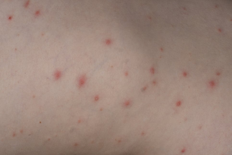 서초 피부과 여드름인줄 알았는데.. 모낭염 원인과 증상은? 관련 이미지 3